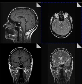 Рентгенови, CT и MRI каква е разликата