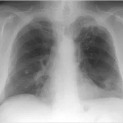 Röntgensugarakat bronchitis