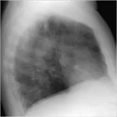 Röntgensugarakat bronchitis