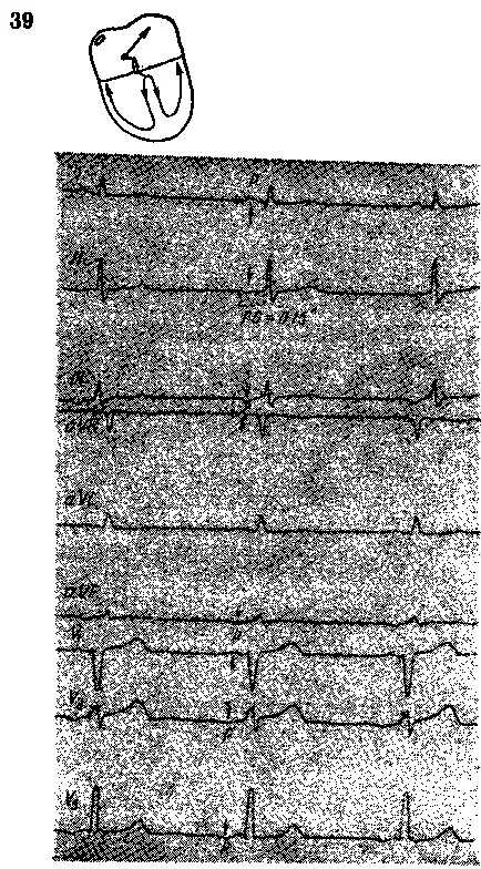 A ritmus a sinus coronarius (sinus venosus coronarius) - studopediya