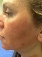 Cicatricile dupa acnee SOS, cont de utilizator cu laser resurfacing Katie (katuharoma) comunitatea este totul despre