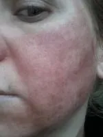 Cicatricile dupa acnee SOS, cont de utilizator cu laser resurfacing Katie (katuharoma) comunitatea este totul despre