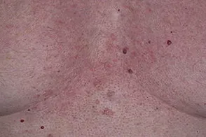 Себореен дерматит Лечение и Симптоми по лицето, главата и тялото, sprosidermatologa