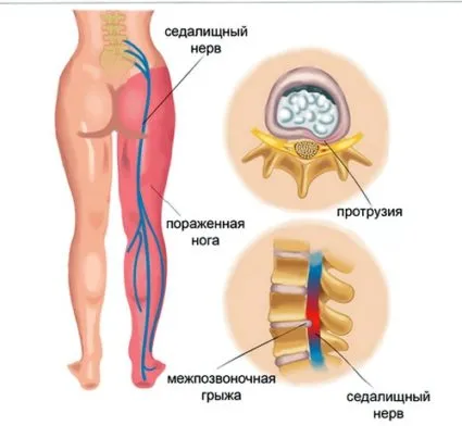 Sciatic nervoase, sciatica, simptome, tratament, diagnosticarea, prevenirea