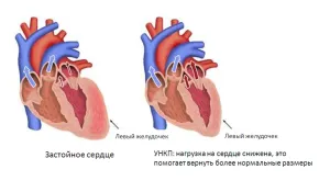 Сърдечна недостатъчност - причини, симптоми и народната медицина лечение на сърдечна недостатъчност