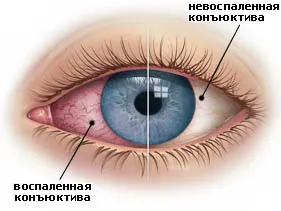 Симптомите на конюнктивит и разлики от dacryocystitis