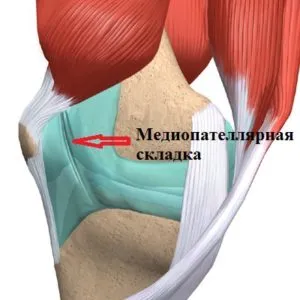 Mediopatellyarnoy szindróma a térd gyűrődések