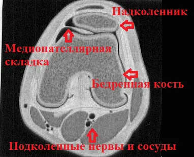 Sindromul hipertrofiată al mediopatellyarnoy cutelor genunchiului