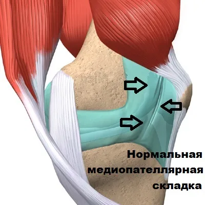 Hipertrófiás szindróma a térd gyűrődések mediopatellyarnoy
