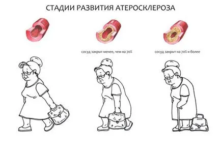 A tünetek az atherosclerosis (jellemzők) - a kezdeti, első, külső, időskori