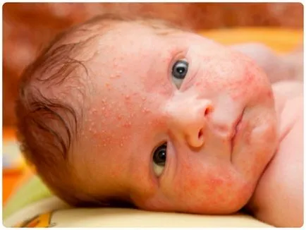 A kiütés az arcon egy gyerek egy hónap, milyen veszélyek leselkednek a baba