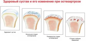 Етап остеоартрит симптоми и лечения