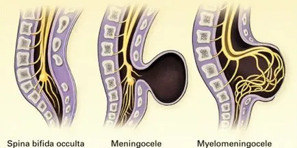 Spina bifida, care este, de tratament, chirurgie, consecințe