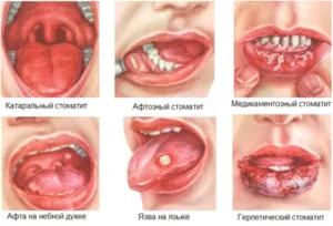 Стоматит - лечение стоматит в Москва, цени за услуги