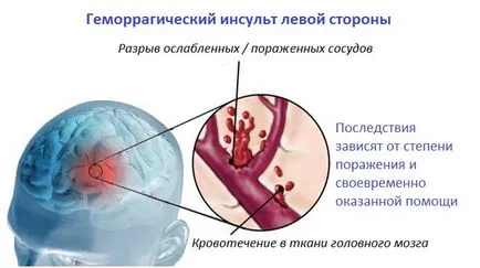 Vérzéses stroke (bal oldal)