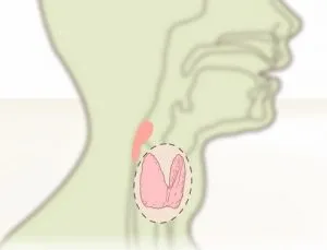 Тиротоксични симптоми и лечение на болестта гуша