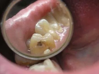 Elmélete eredetét fogszuvasodás - fogszuvasodást kémiai parazita elmélet Miller