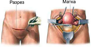 Eliminarea fibrom uterin - miomectomie - Operațiuni și reabilitare