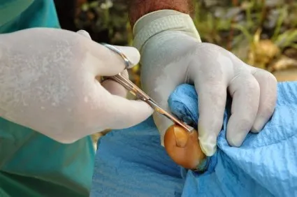 Eltávolítása köröm gomba módszerek, helyreállítási