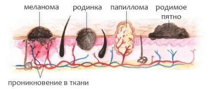 Премахване на брадавици с течен азот ревюта, възможни последствия, цени