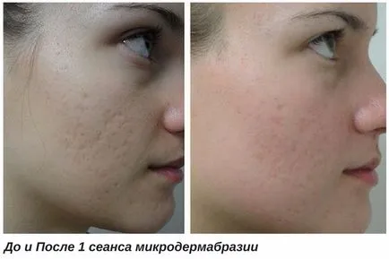 Eliminarea cicatrici pe fata, cicatrici adanci de acnee cu laser, chirurgie si alte metode