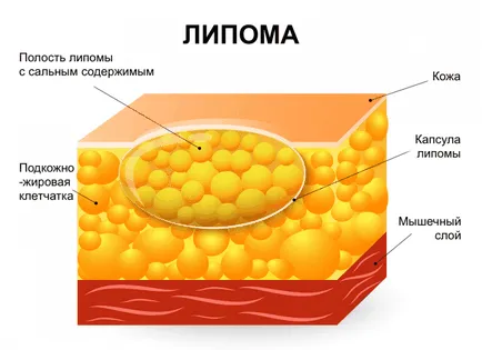 Metode de eliminare Wen tratament chirurgical și medical