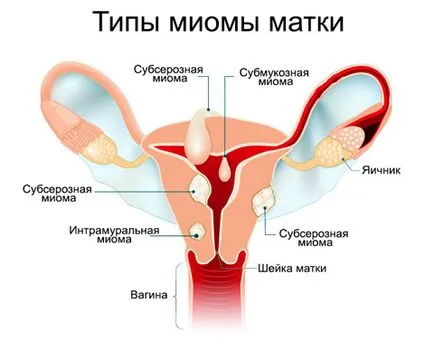 Отстраняване на миома на матката - миомектомия - Експлоатация и рехабилитация