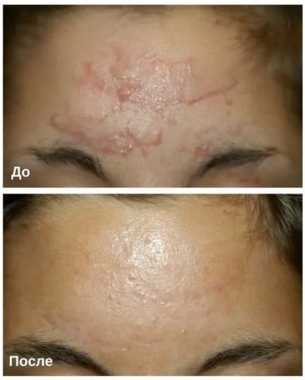 Eliminarea cicatrici pe fata, cicatrici adanci de acnee cu laser, chirurgie si alte metode