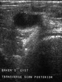 Diagnostic cu ultrasunete chistului Baker - n