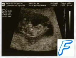 Ultrasonografie (SUA) în timpul sarcinii