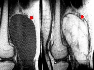 Diagnostic cu ultrasunete chistului Baker - n