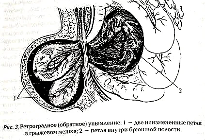 заклещена херния