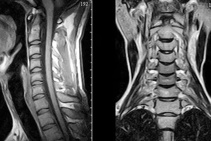 pensarea nervului la nivelul coloanei vertebrale toracice, nevralgia a coloanei vertebrale cervicale, simptome și tratament