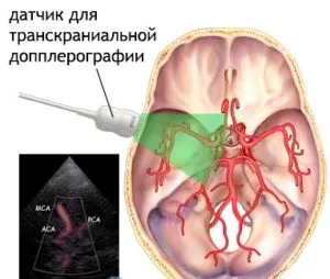 Узи съдове на главата и шията (БМА ултразвук и TCD) на ултразвук Доктора