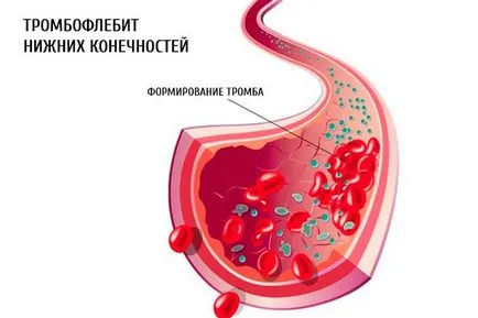 Varikotromboflebit - cauze, simptome și tratament