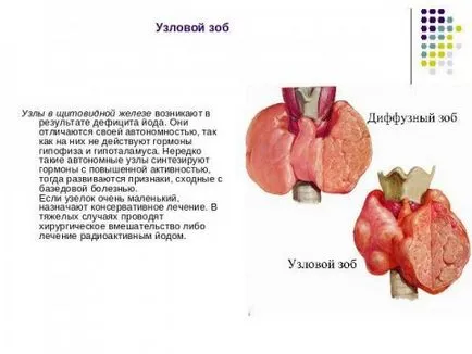 Nodosus struma a pajzsmirigy kezelésére, a tünetek és a mértéke a betegség