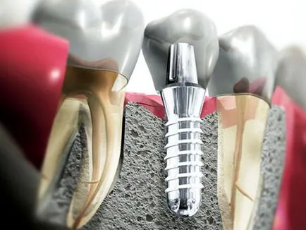 Tipuri de implanturi dentare descrie tehnicile de bază