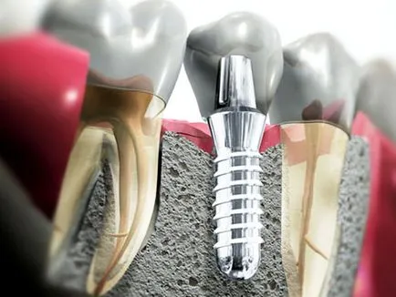 Видове зъбни импланти описва основните техники