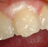 Vnutrikoronkovoe избелване, статии за избелване на зъбите