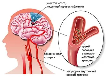 Întrebare și răspuns în cazul în care memoria este restabilită după un accident vascular cerebral ischemic