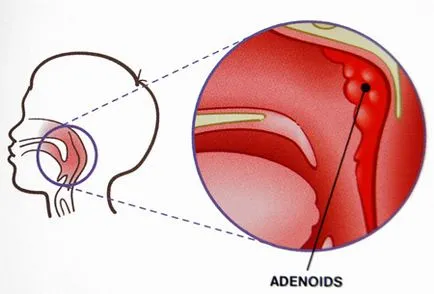 Inflamarea adenoids copilul de 3 ani