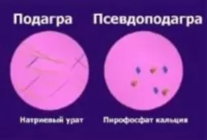 Chondrocalcinosis, tünetek, panaszok kezelésére