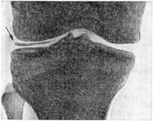 Chondrocalcinosis, tünetek, panaszok kezelésére