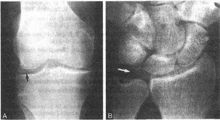 Chondrocalcinosis, tünetek, panaszok kezelésére