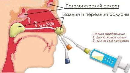 процедура YAMIK за лечение на синузит, предимствата и недостатъците