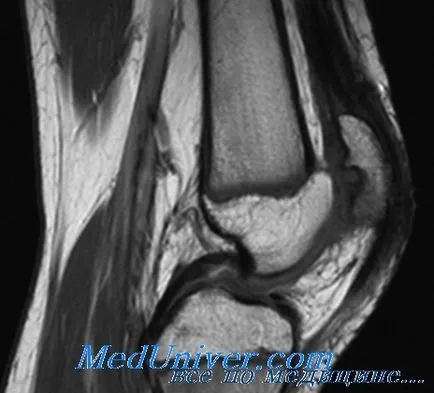 Chondromalacia patella - patella elmozdulás szindróma