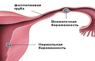 Течността в матката води в напреднала възраст и след раждането, какво означава това