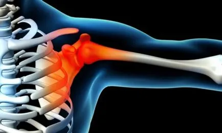 Hogyan kell kezelni capsulitis a váll ízületi szindróma tünetei és kezelése befagyott váll népi