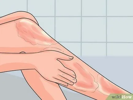 Cum de a trata arsurile pielii cu apă caldă