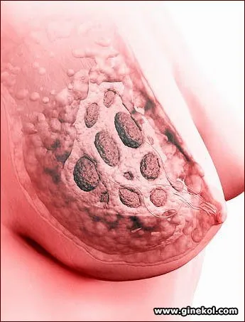 boala de san, ginecologie si obstetrica